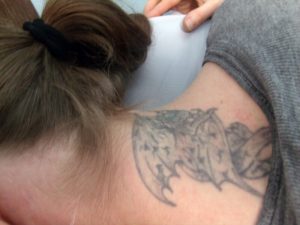 Neck Tattoo Laser Removal Before